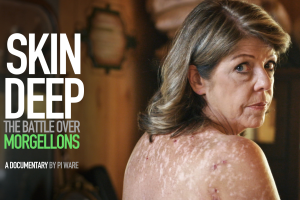 A middle aged White woman stares back at us, her back covered in skin discolorations.